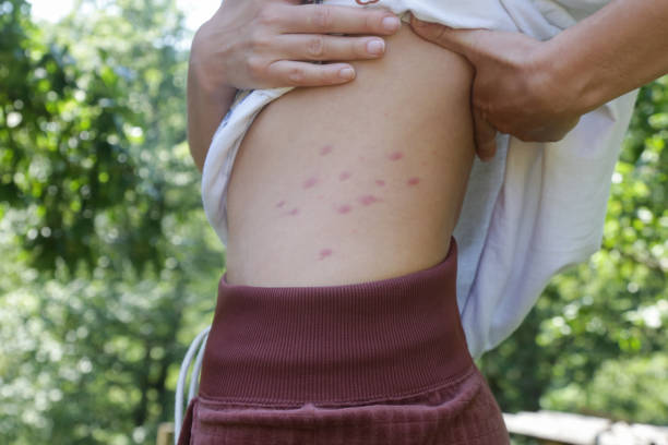 bouton punaise de lit allergie