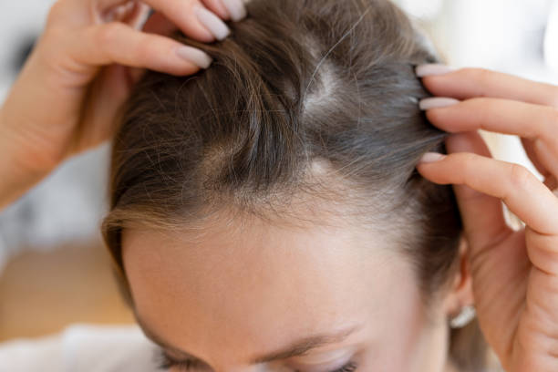 puces dans les cheveux
